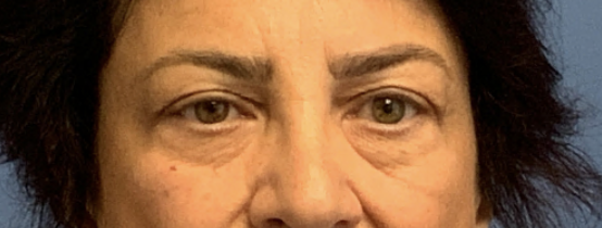 Upper-Blepharoplasty--Case-Study-859 | Before Face